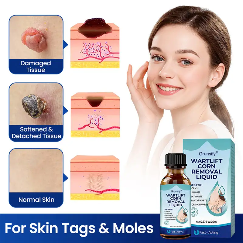 Grunsify® Wart Lift Corn Removal Liquid-No Recurrence After Cure