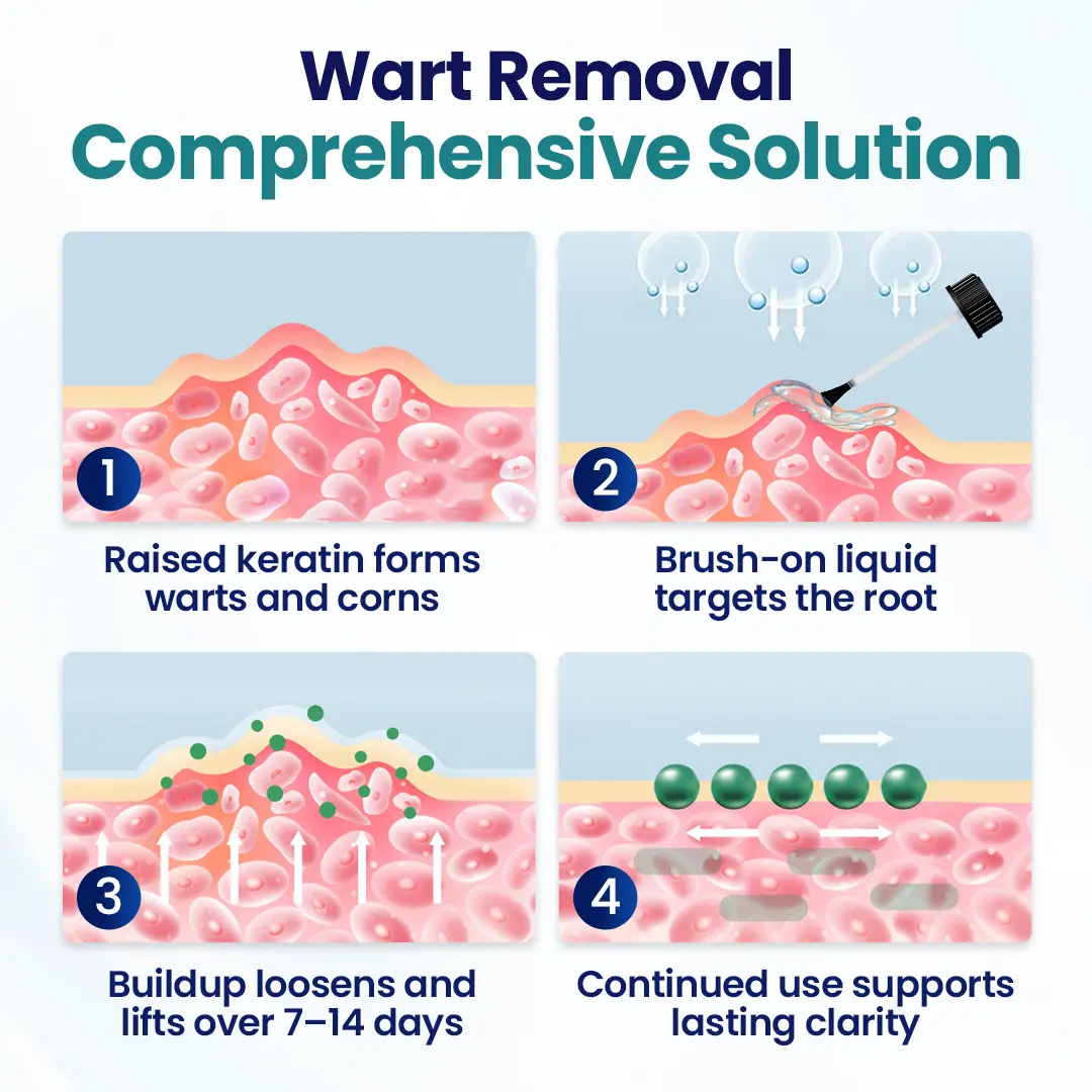 Grunsify® Wart Lift Corn Removal Liquid-No Recurrence After Cure